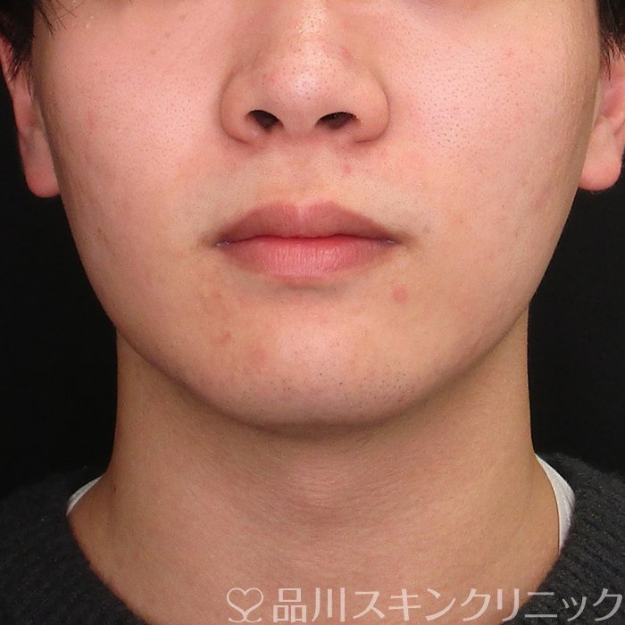 症例NO.73907のAFTER写真