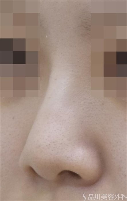 症例NO.54368のAFTER写真