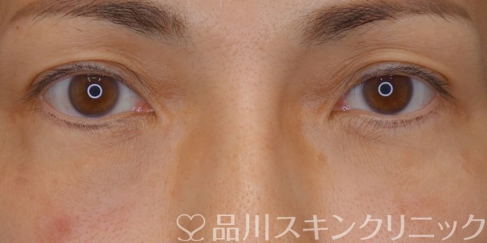 症例NO.71007のAFTER写真