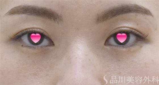 症例NO.52121のAFTER写真