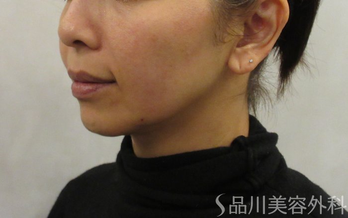 症例NO.73752のAFTER写真