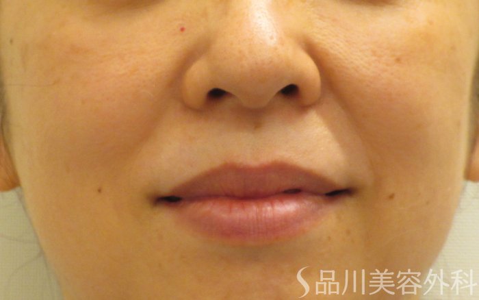 症例NO.70395のBEFORE写真
