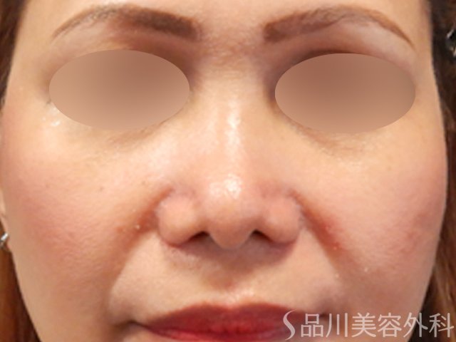 症例NO.71796のAFTER写真