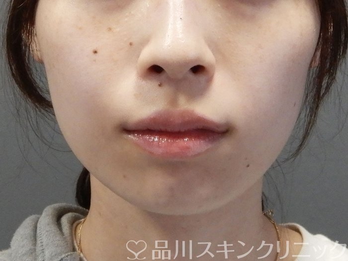 症例NO.70601のBEFORE写真