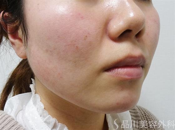 症例NO.51262のBEFORE写真