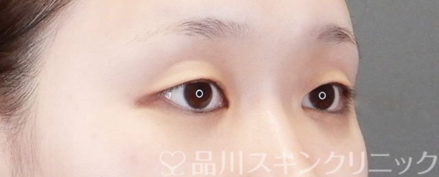 症例NO.75272のBEFORE写真