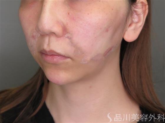 症例NO.48813のAFTER写真