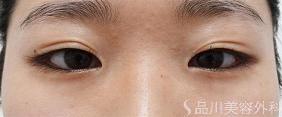 症例NO.57014のBEFORE写真