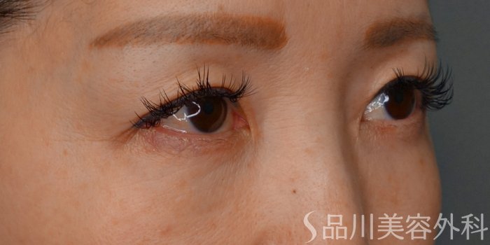 症例NO.73235のBEFORE写真