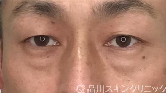 症例NO.57336のBEFORE写真