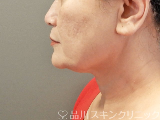 症例NO.66542のAFTER写真