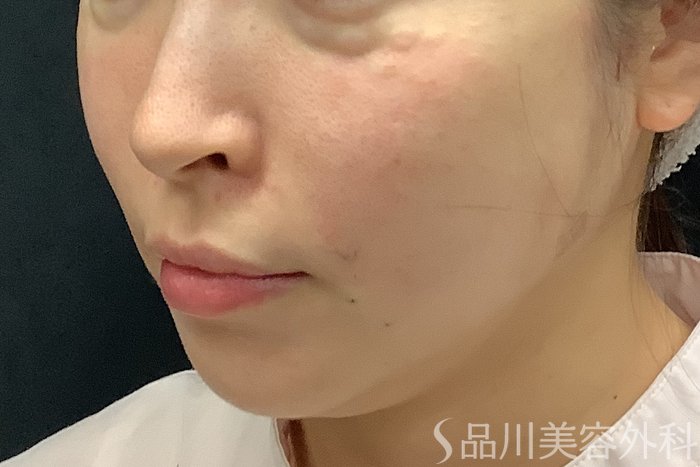 症例NO.71243のAFTER写真