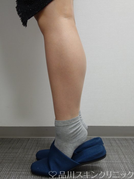 症例NO.75377のBEFORE写真