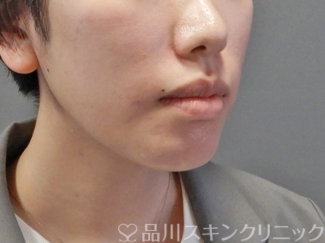 症例NO.64460のAFTER写真