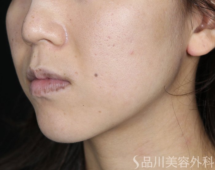 症例NO.72086のBEFORE写真