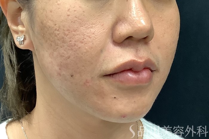 症例NO.73310のAFTER写真