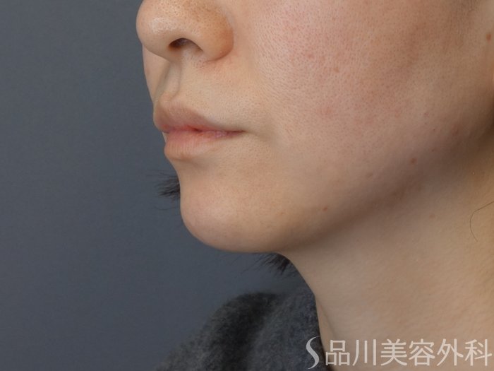 症例NO.72611のAFTER写真