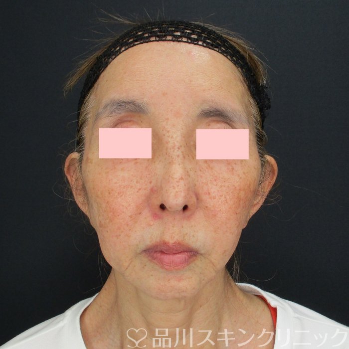症例NO.69850のBEFORE写真