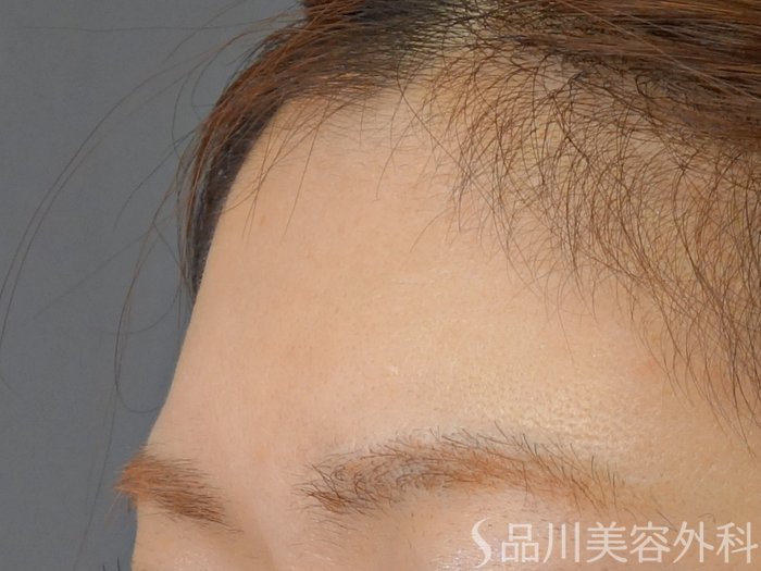 症例NO.72860のBEFORE写真