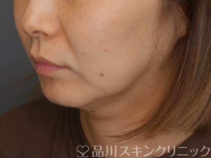 症例NO.70865のBEFORE写真