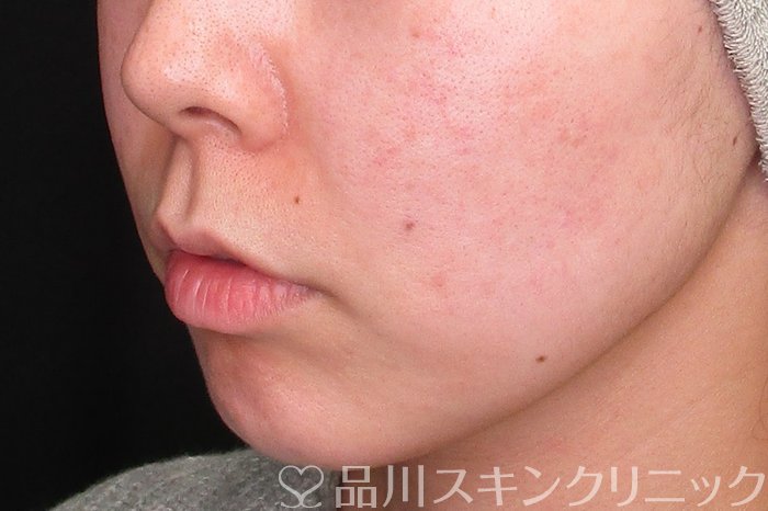 症例NO.73631のBEFORE写真