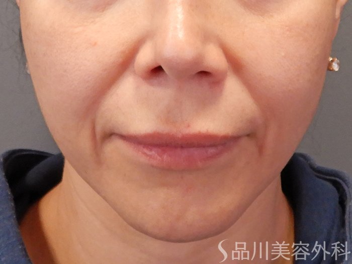 症例NO.69871のBEFORE写真