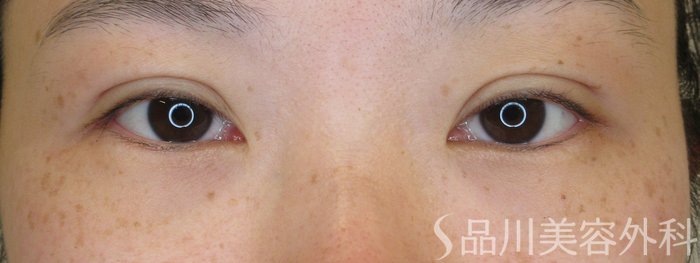 症例NO.72091のAFTER写真