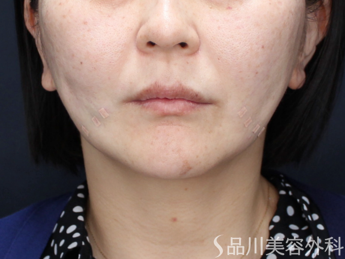 症例NO.71633のAFTER写真