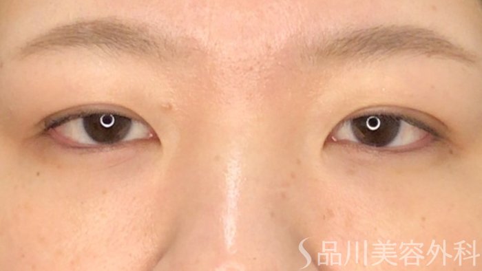 症例NO.71781のAFTER写真