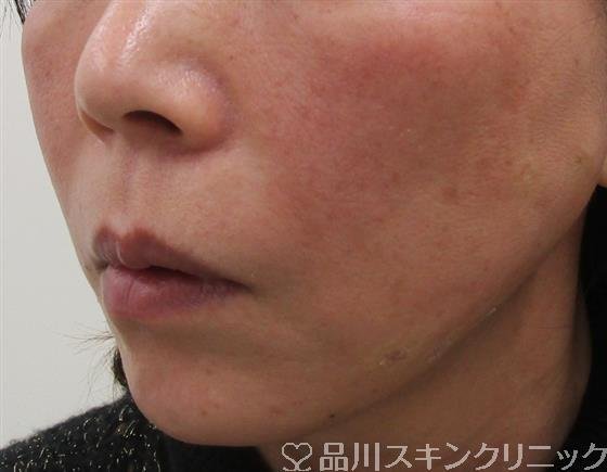 症例NO.41814のAFTER写真