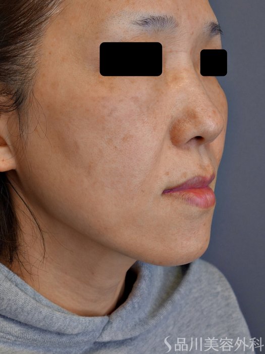 症例NO.75032のBEFORE写真