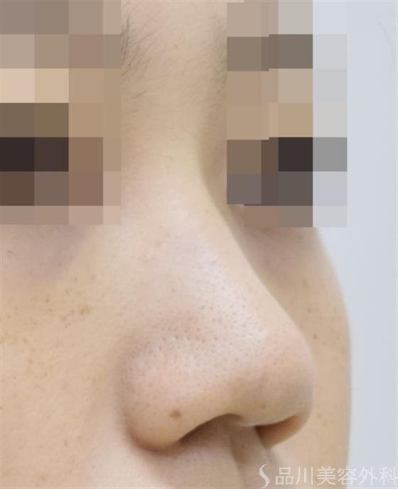 症例NO.44115のBEFORE写真