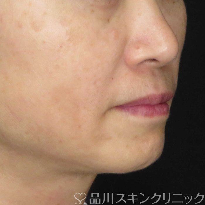 症例NO.62166のAFTER写真