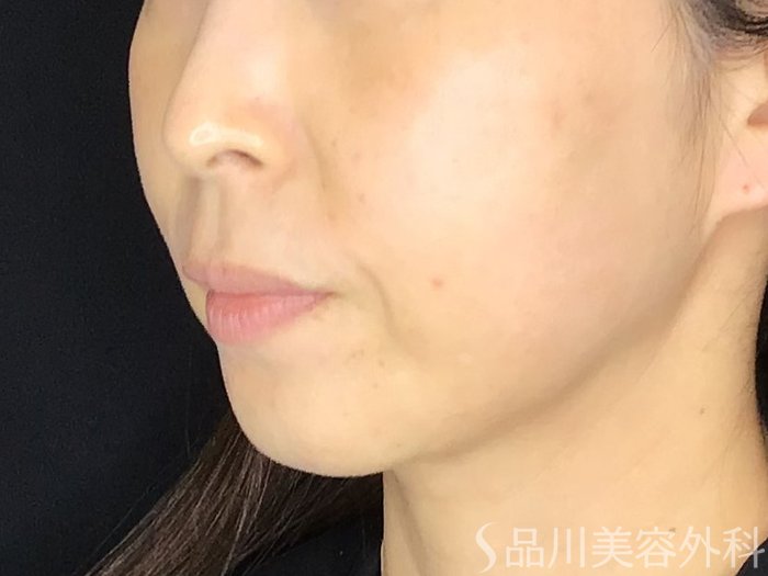 症例NO.67984のBEFORE写真