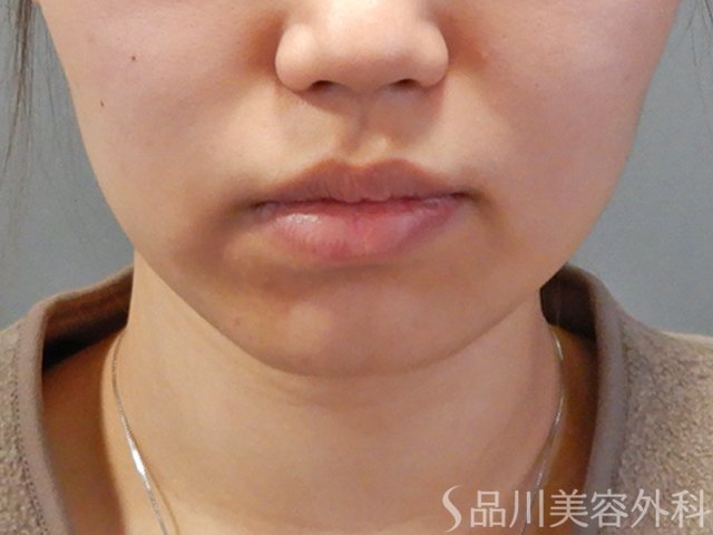 症例NO.74963のBEFORE写真