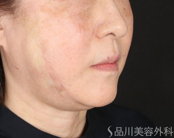 症例NO.72958のAFTER写真