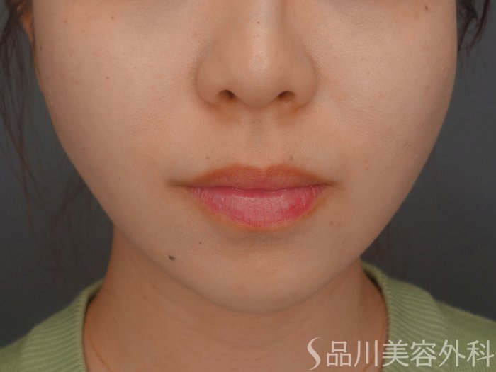 症例NO.73432のAFTER写真