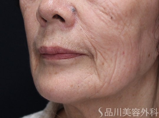 症例NO.74168のBEFORE写真