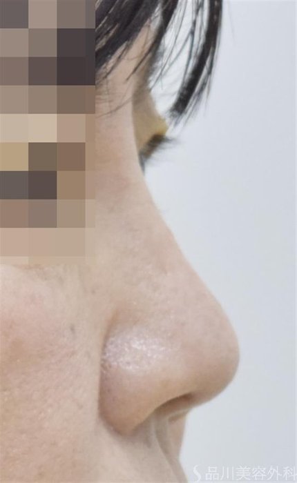 症例NO.51712のAFTER写真
