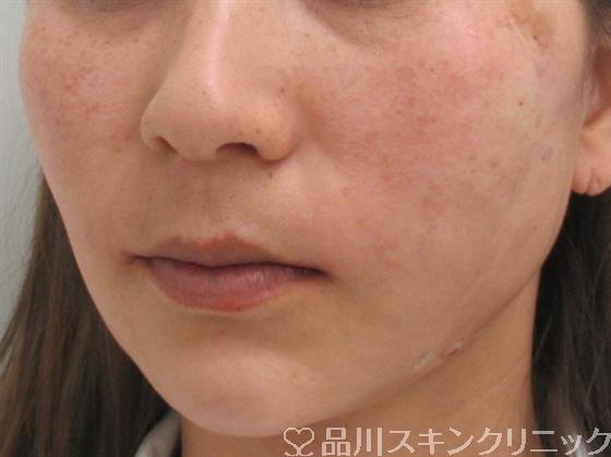 症例NO.26761のAFTER写真