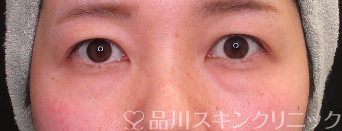 症例NO.64267のBEFORE写真