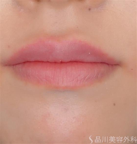 症例NO.53868のAFTER写真