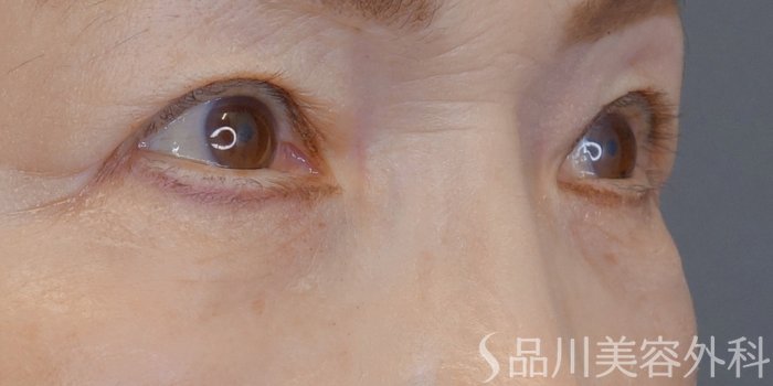 症例NO.72206のAFTER写真