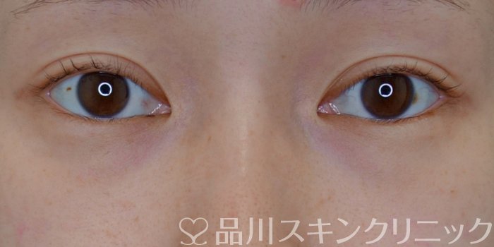 症例NO.72481のBEFORE写真