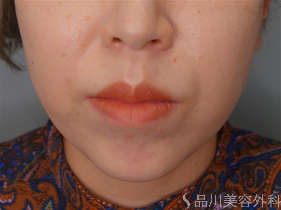 症例NO.53670のBEFORE写真