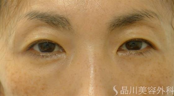 症例NO.49898のAFTER写真
