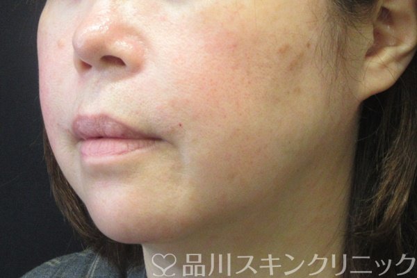 症例NO.67978のAFTER写真