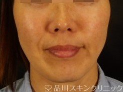 症例NO.72355のBEFORE写真