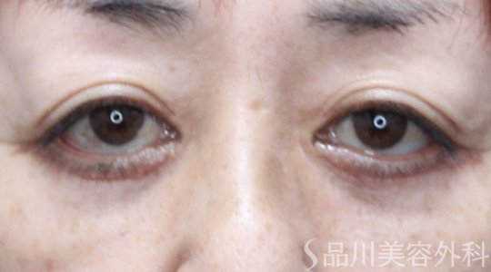 症例NO.71148のAFTER写真