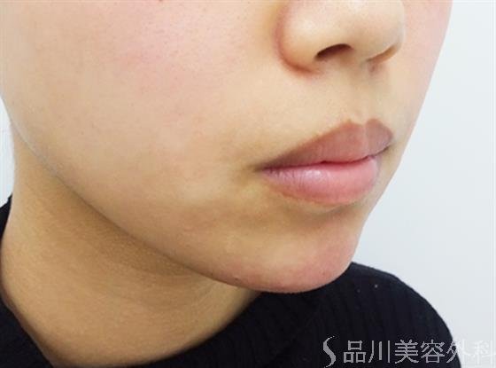 症例NO.40864のAFTER写真
